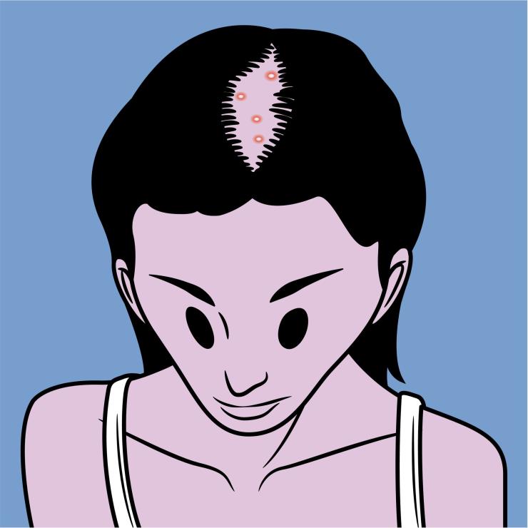 탈모 자가 진단 여성 탈모