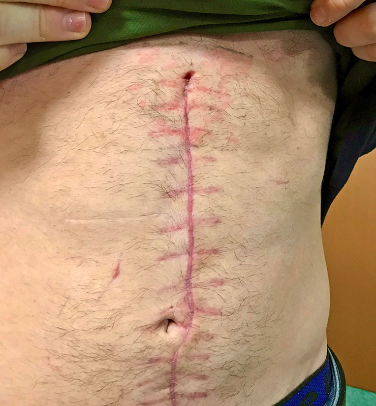 수술 자국을 보여주는 국제 여단의 봉사자 조시. &copy; BENJAMIN BUSCH